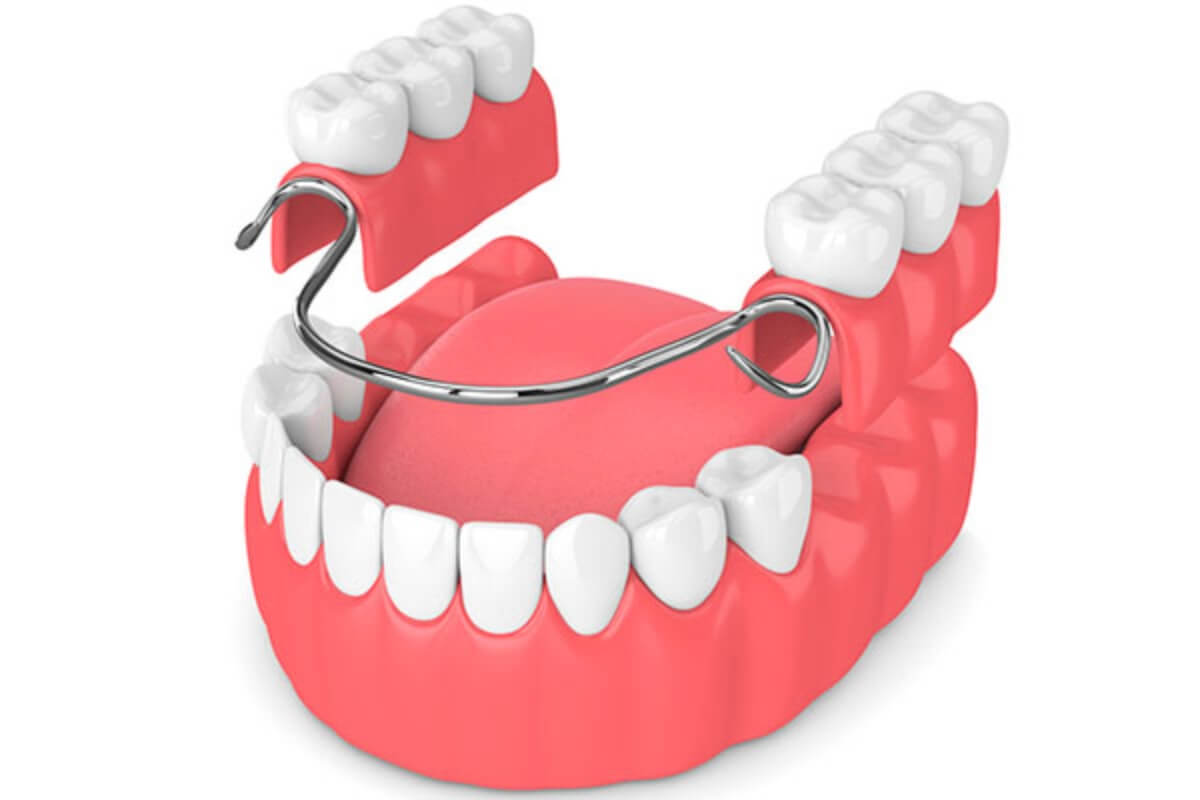 implantes-provisionales